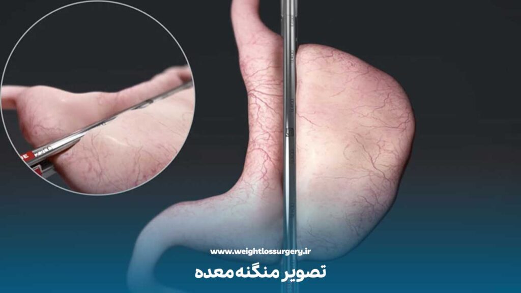 تصویر منگنه معده