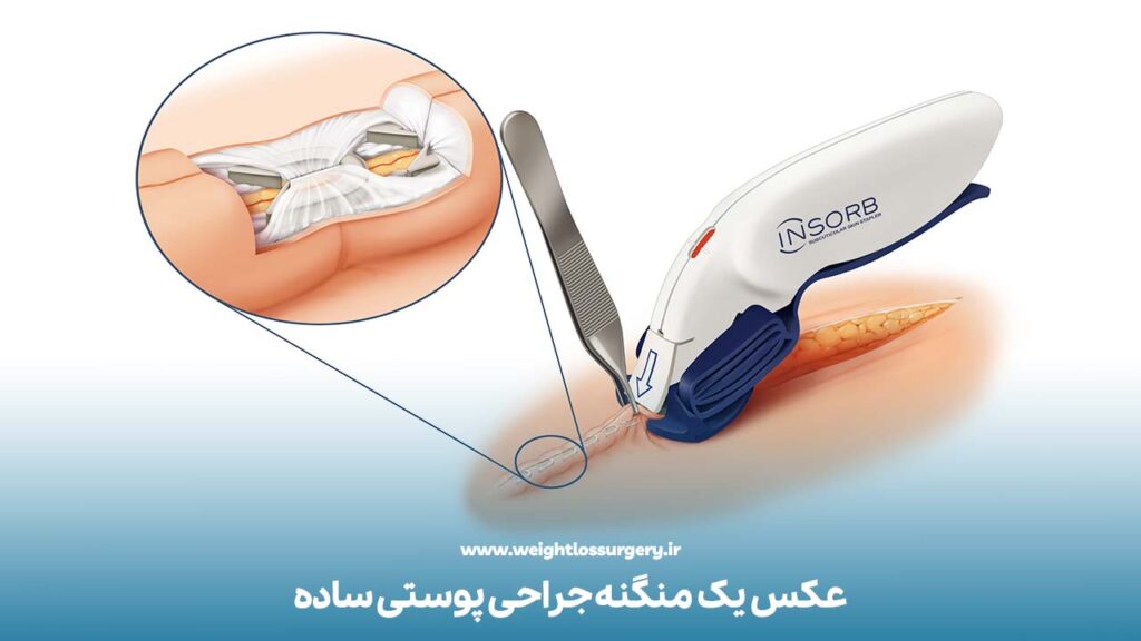 عکس یک منگنه جراحی پوستی ساده