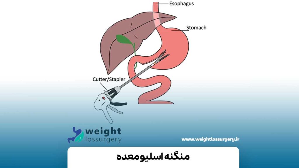 منگنه اسلیو معده