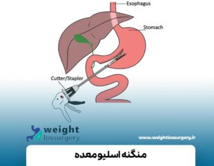 منگنه اسلیو معده