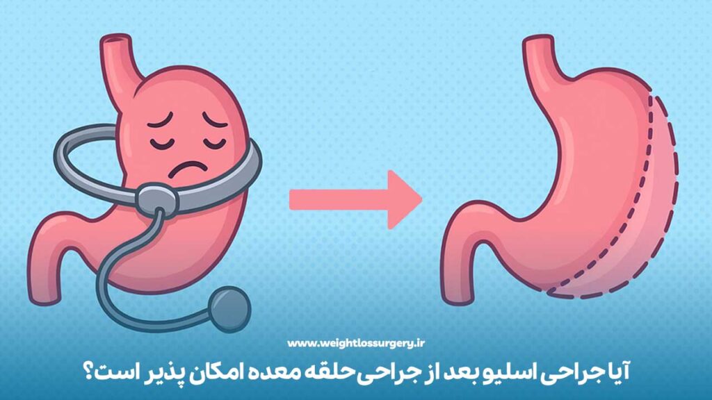 آیا جراحی اسلیو بعد از جراحی حلقه معده امکان پذیر است؟