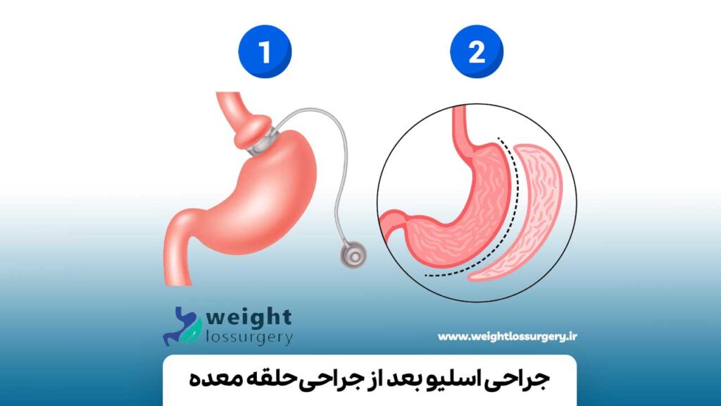 جراحی اسلیو بعد از جراحی باندینگ معده
