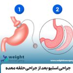 جراحی اسلیو بعد از جراحی باندینگ معده