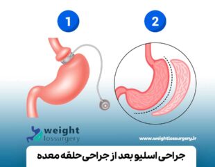 جراحی اسلیو بعد از جراحی باندینگ معده