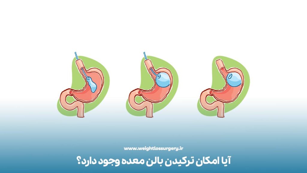 آیا امکان ترکیدن بالن معده وجود دارد؟