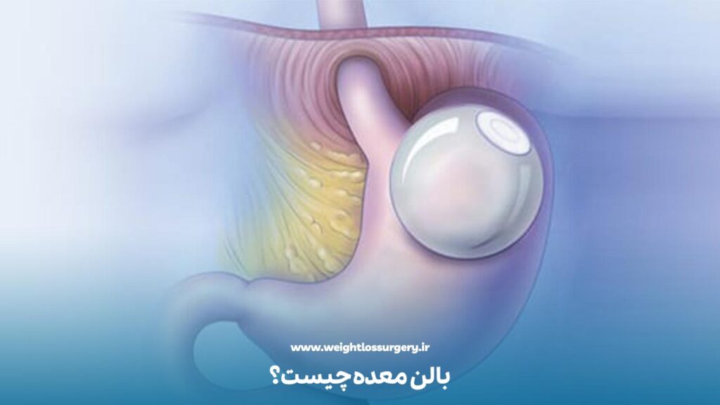 بالن معده چیست