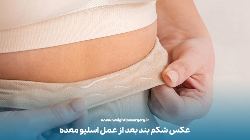 عکس شکم بند بعد از عمل اسلیو معده