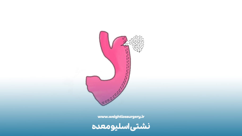 نشتی اسلیو معده